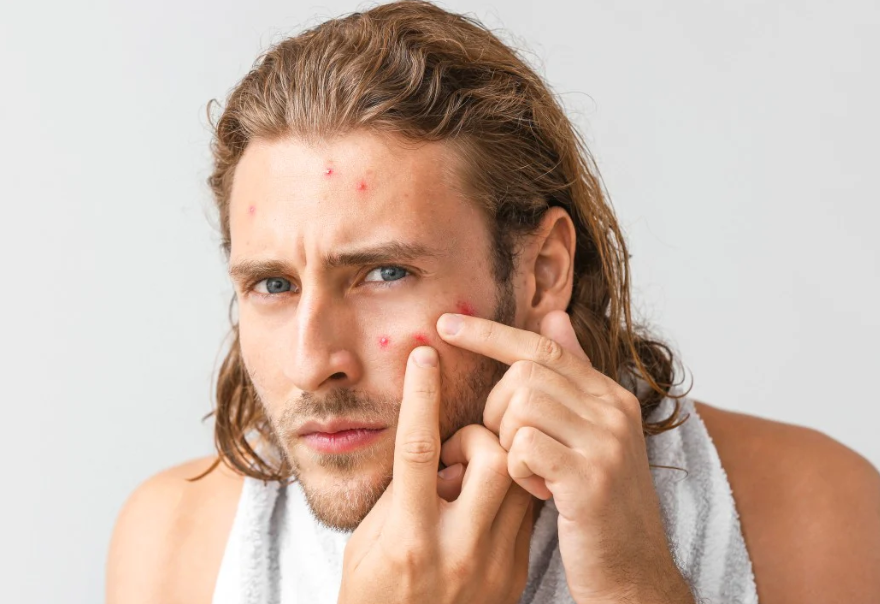 Pimples On Forehead mens
