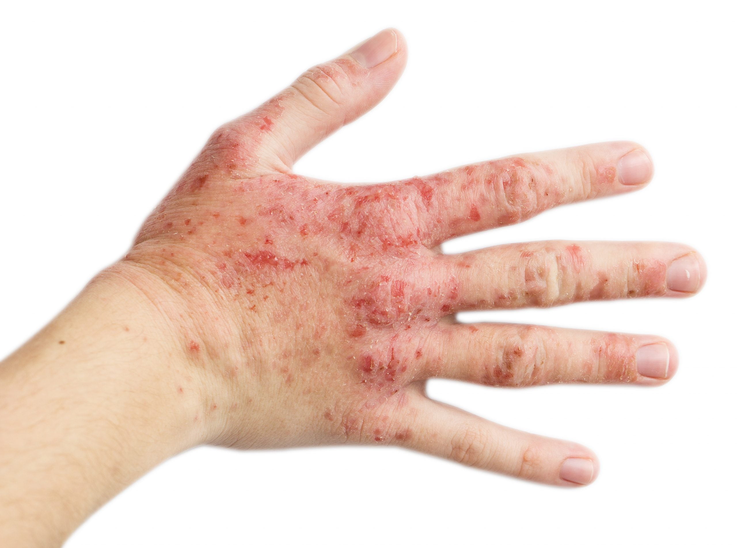 Dermatomyositis