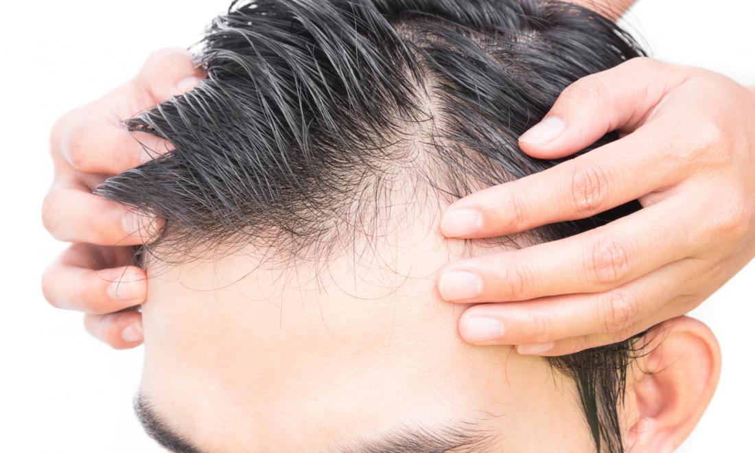 Tips to manage hair fall for mens