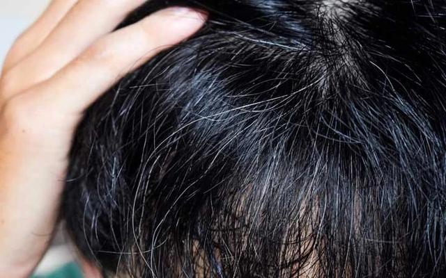 Premature Greying In Men