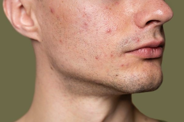 Acne Prone Skin mens