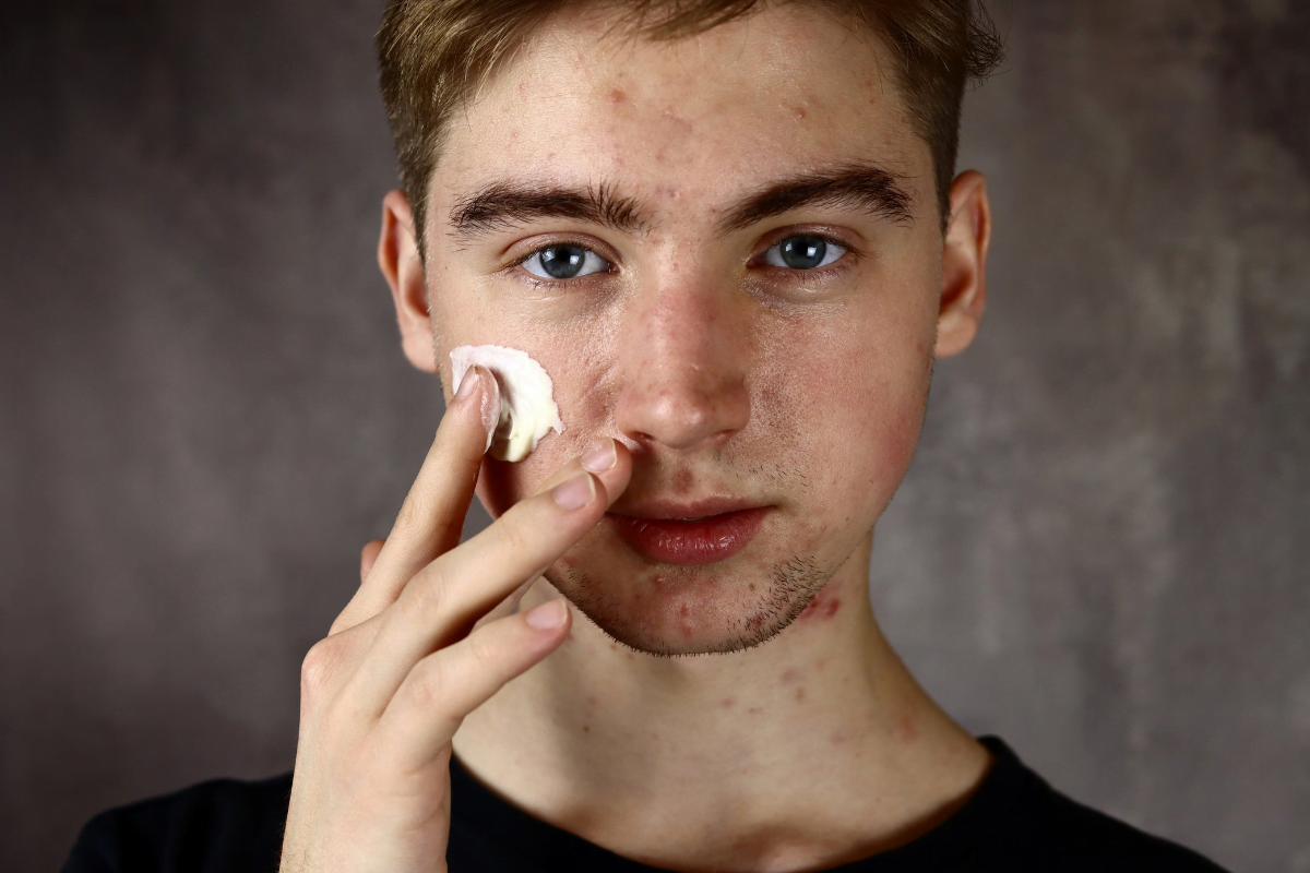 Men With Acne Prone Skin