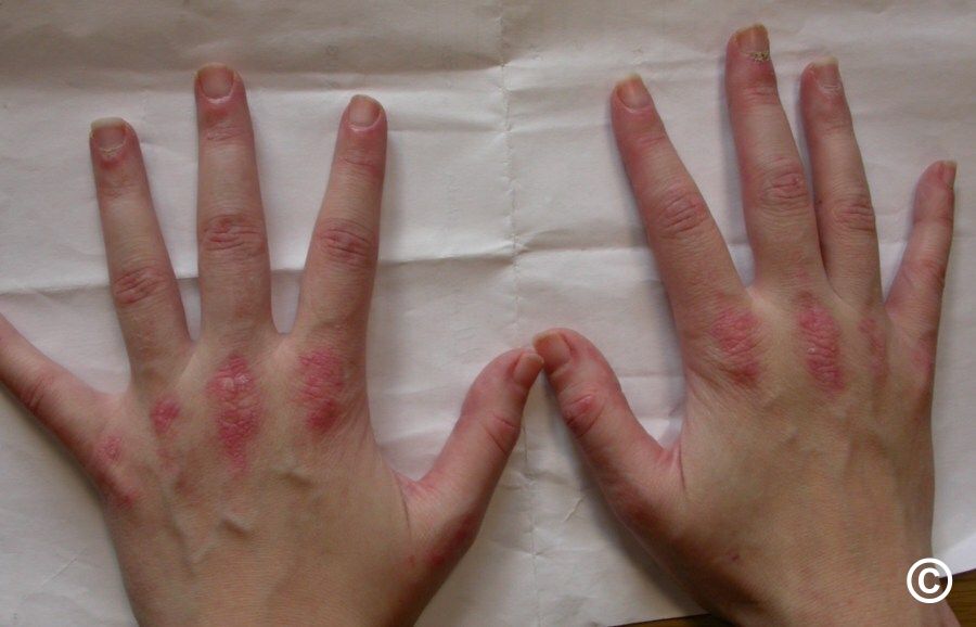 Dermatomyositis