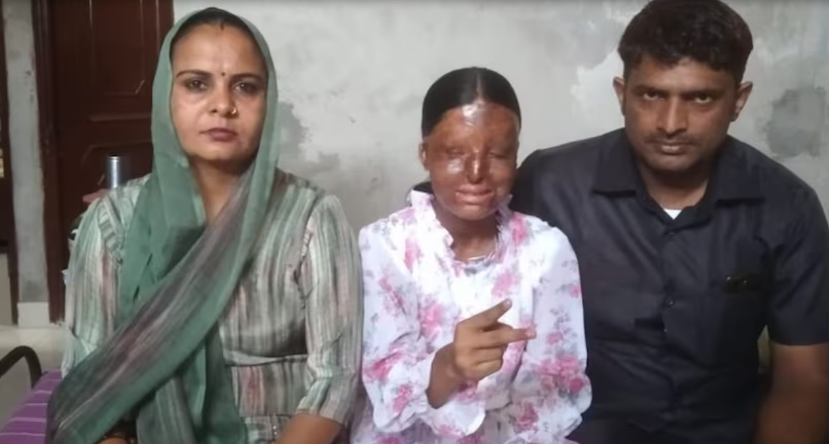 Acid attack victim topped CBSE
